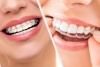 ارتودنسی ثابت یا متحرک؟ تفاوت‌ها، مزایا و معایب هرکدام